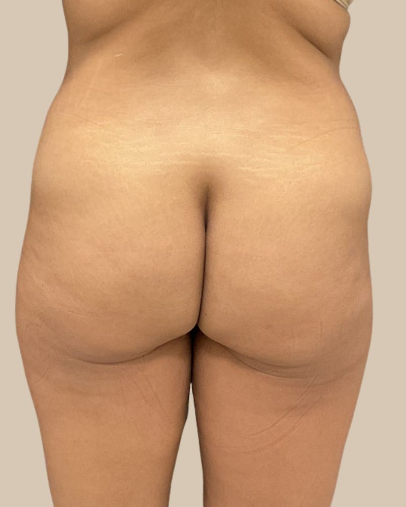 Liposuction Before & After Gallery - Patient 372314 - Image 13