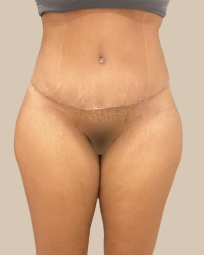 Liposuction Before & After Gallery - Patient 372314 - Image 2