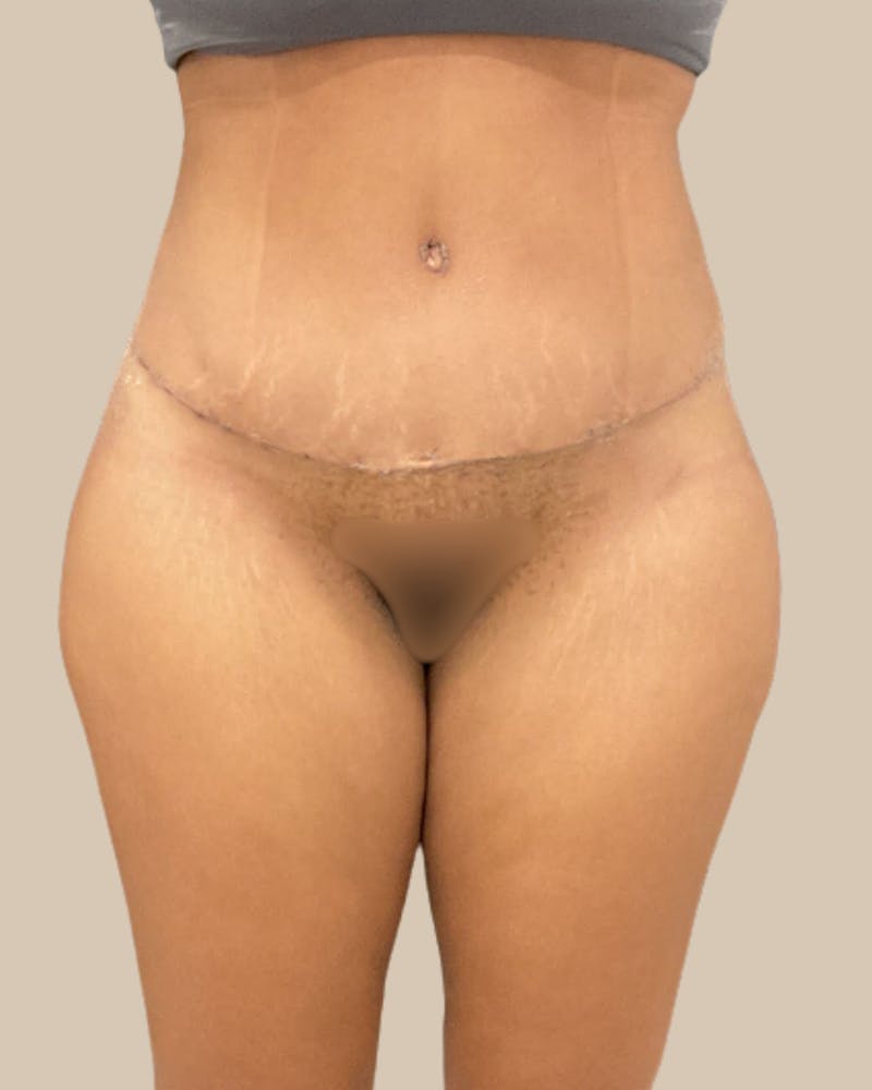 Liposuction Before & After Gallery - Patient 372314 - Image 2