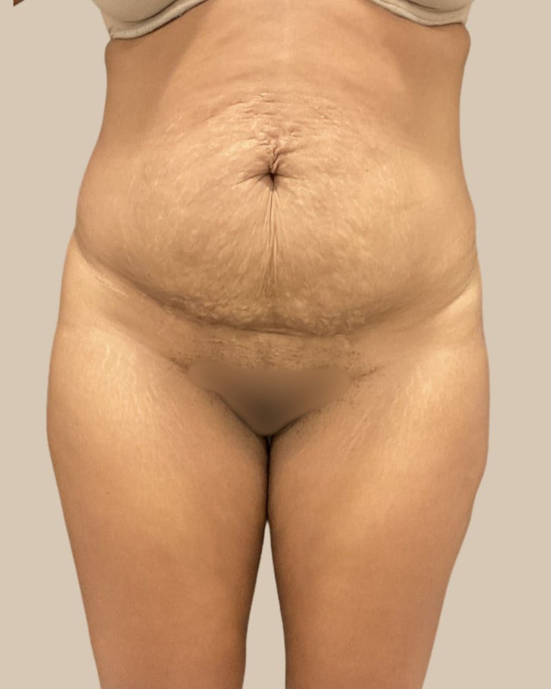 Liposuction Before & After Gallery - Patient 372314 - Image 1