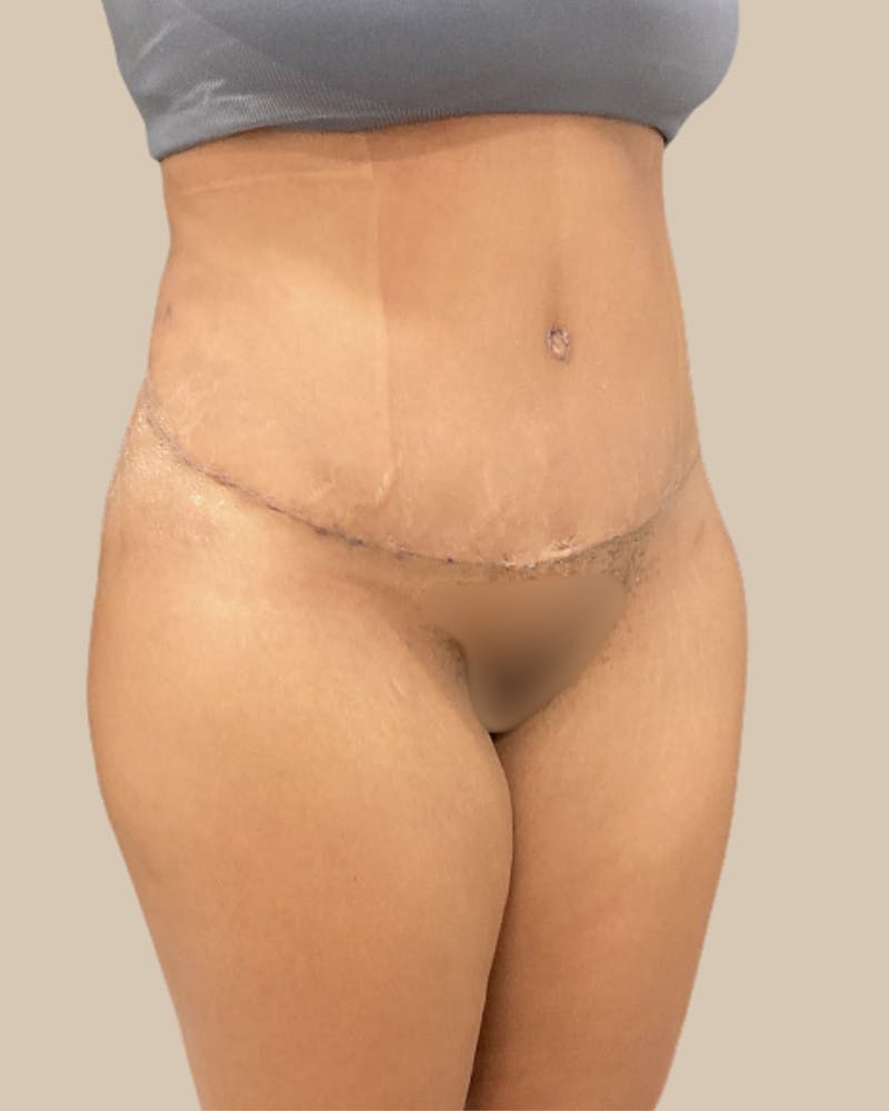 Liposuction Before & After Gallery - Patient 372314 - Image 4
