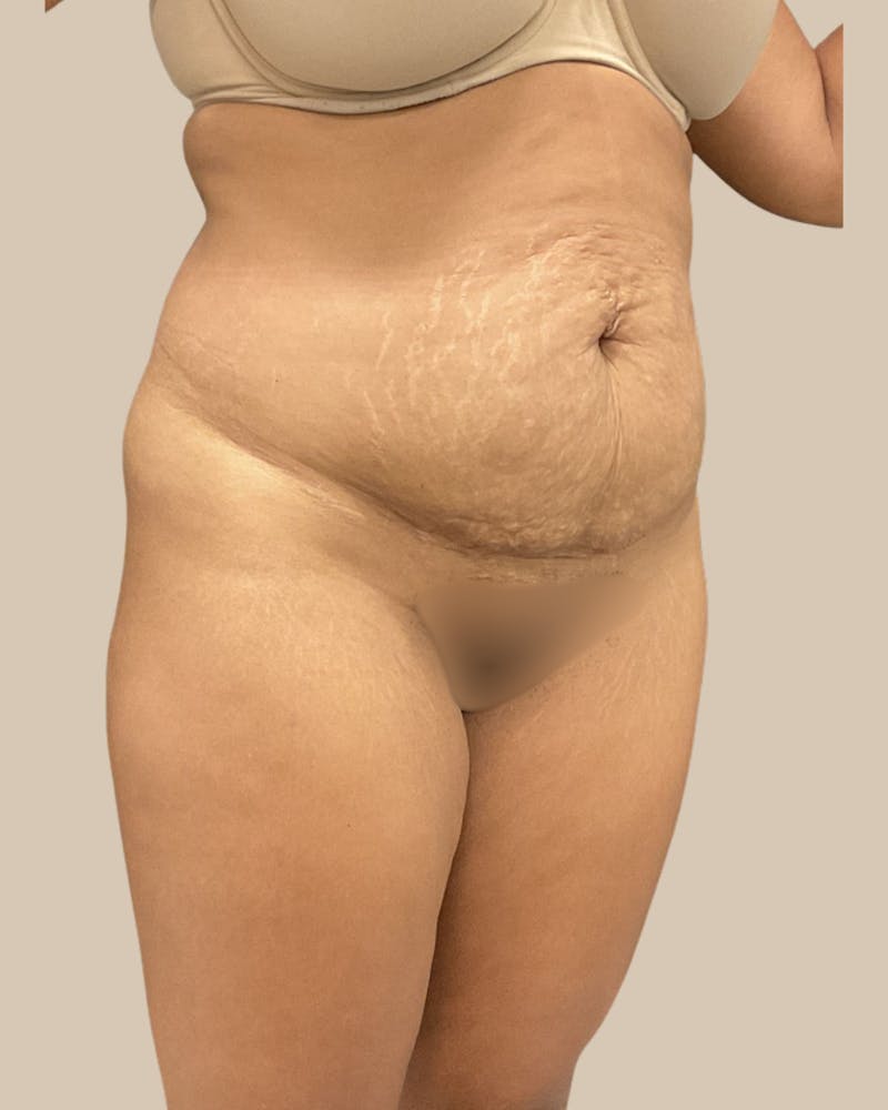 Liposuction Before & After Gallery - Patient 372314 - Image 3