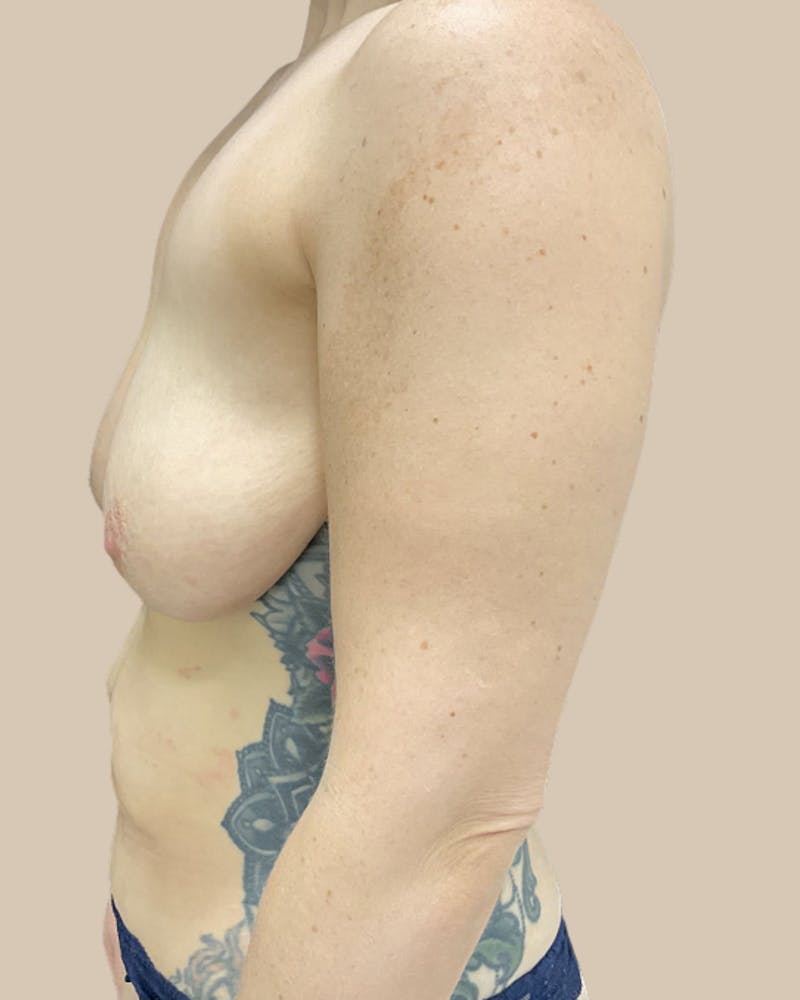 Liposuction Before & After Gallery - Patient 234580 - Image 9