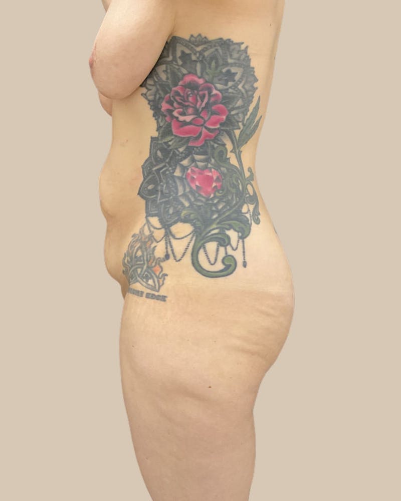 Liposuction Before & After Gallery - Patient 234580 - Image 11