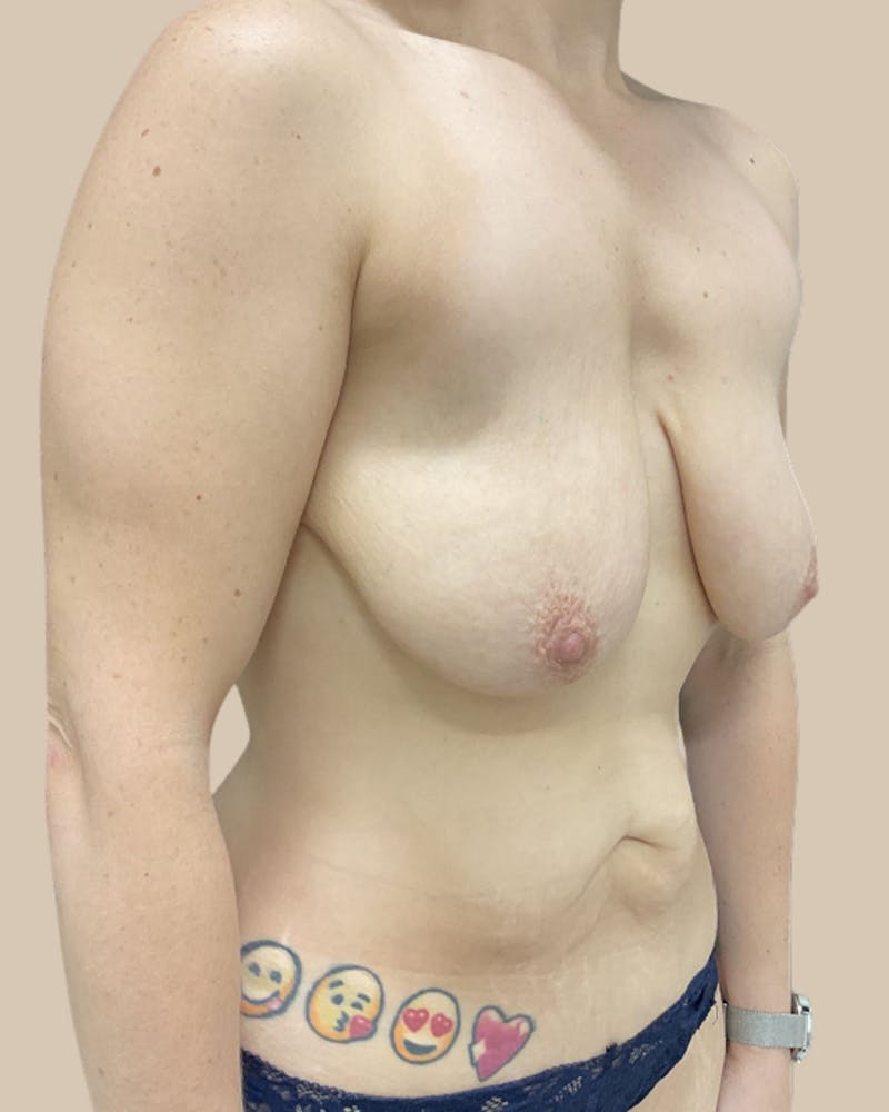Liposuction Before & After Gallery - Patient 234580 - Image 7