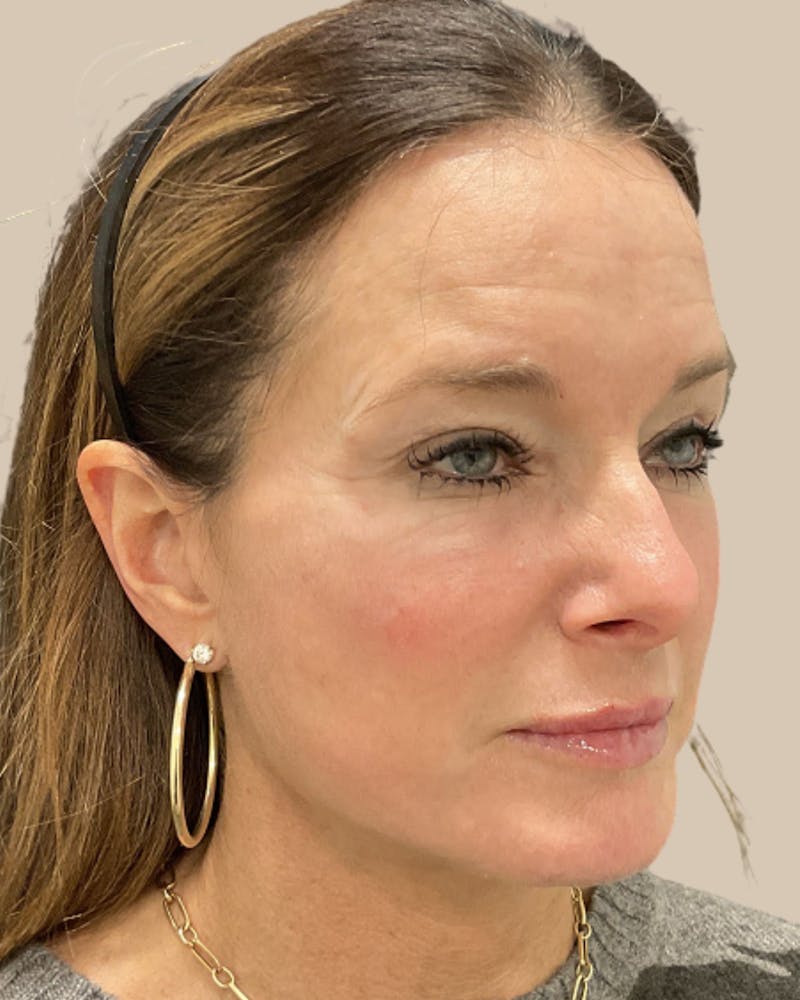 Facelift Before & After Gallery - Patient 205508 - Image 6