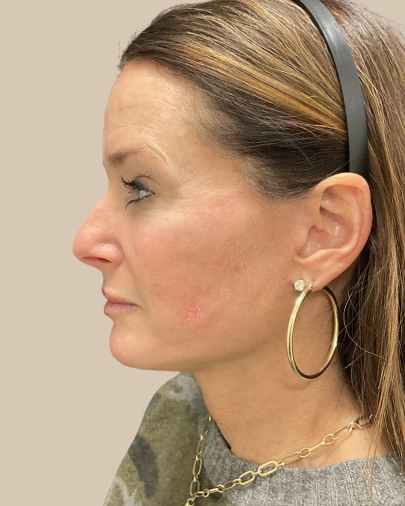 Facelift Before & After Gallery - Patient 205508 - Image 8