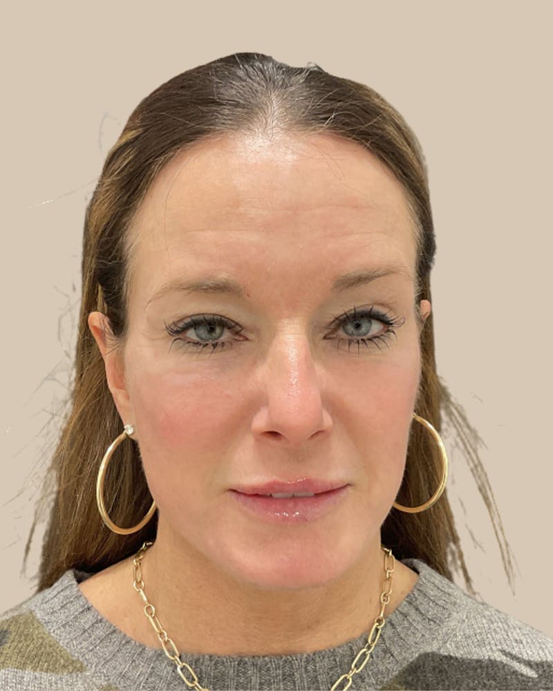 Facelift Before & After Gallery - Patient 205508 - Image 2