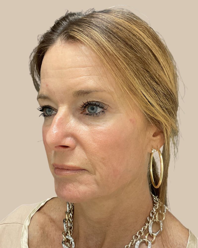 Facelift Before & After Gallery - Patient 205508 - Image 3