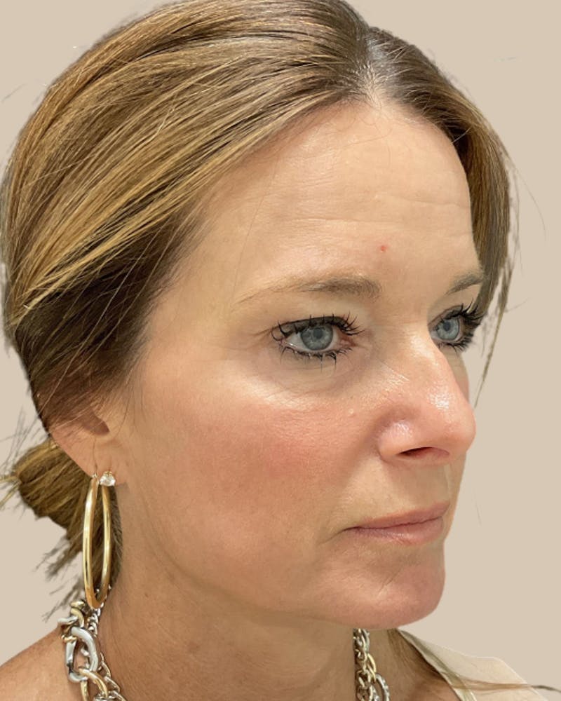 Facelift Before & After Gallery - Patient 205508 - Image 5