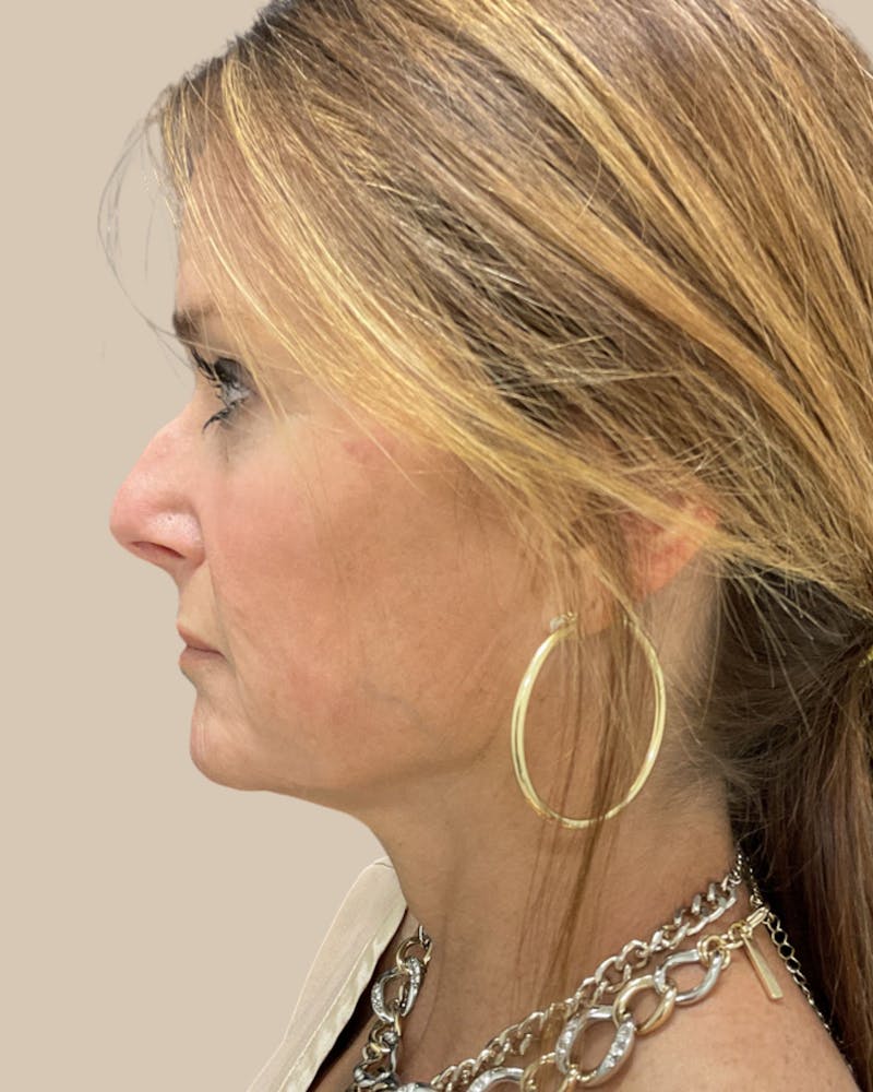 Facelift Before & After Gallery - Patient 205508 - Image 7