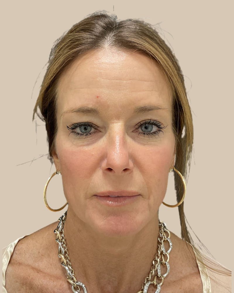 Facelift Before & After Gallery - Patient 205508 - Image 1