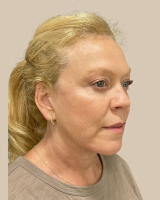 Brow Lift Before & After Gallery - Patient 207716 - Image 6