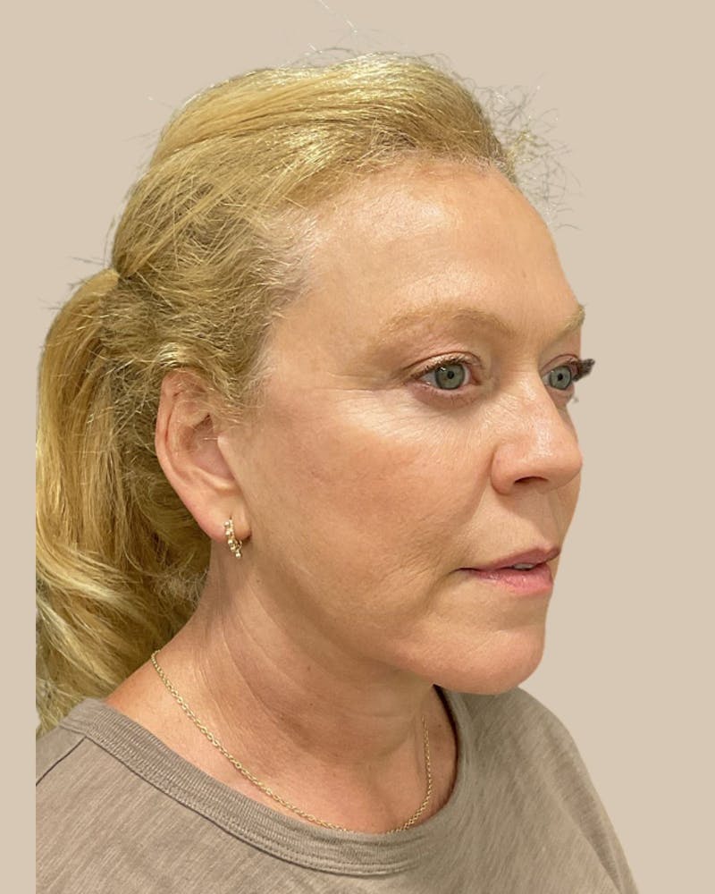 Brow Lift Before & After Gallery - Patient 207716 - Image 6