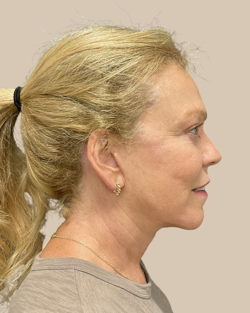 Brow Lift Before & After Gallery - Patient 207716 - Image 8