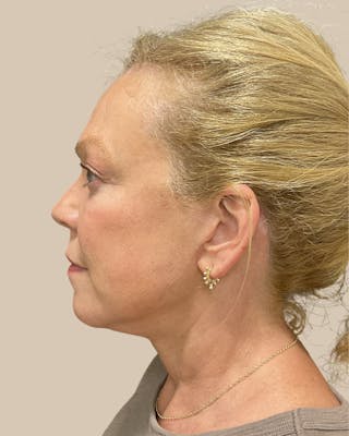 Brow Lift Before & After Gallery - Patient 207716 - Image 10