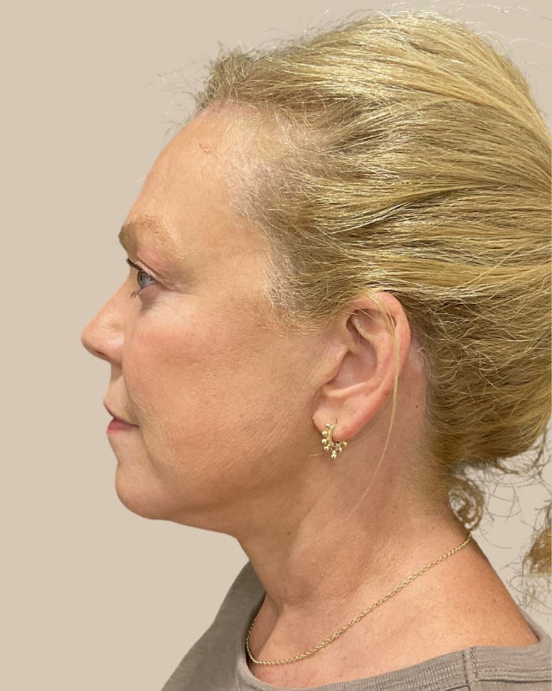Brow Lift Before & After Gallery - Patient 207716 - Image 10