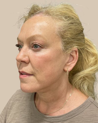 Brow Lift Before & After Gallery - Patient 207716 - Image 2