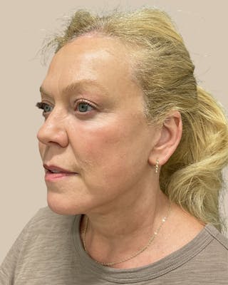 Brow Lift Before & After Gallery - Patient 207716 - Image 2