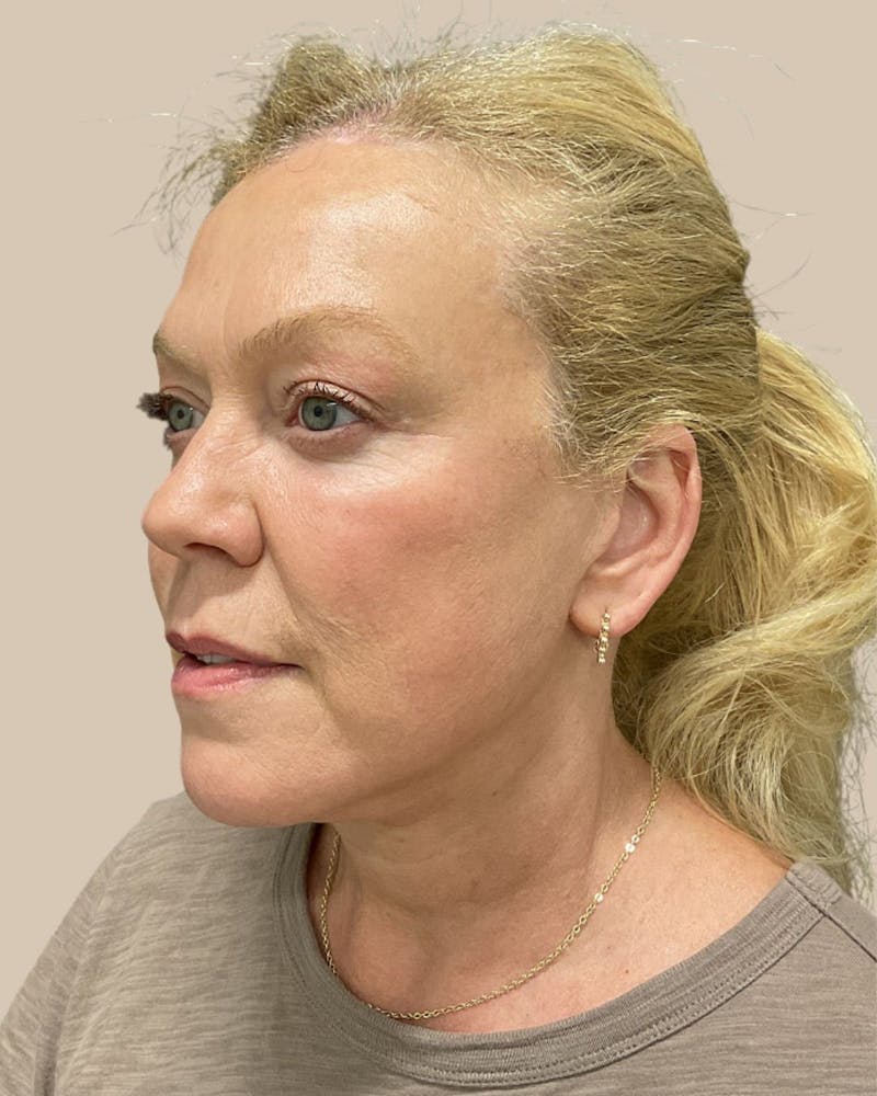 Brow Lift Before & After Gallery - Patient 207716 - Image 2