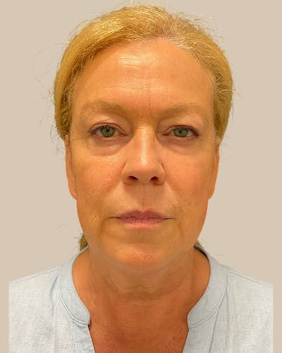 Facial Fat Grafting Before & After Gallery - Patient 562685 - Image 1