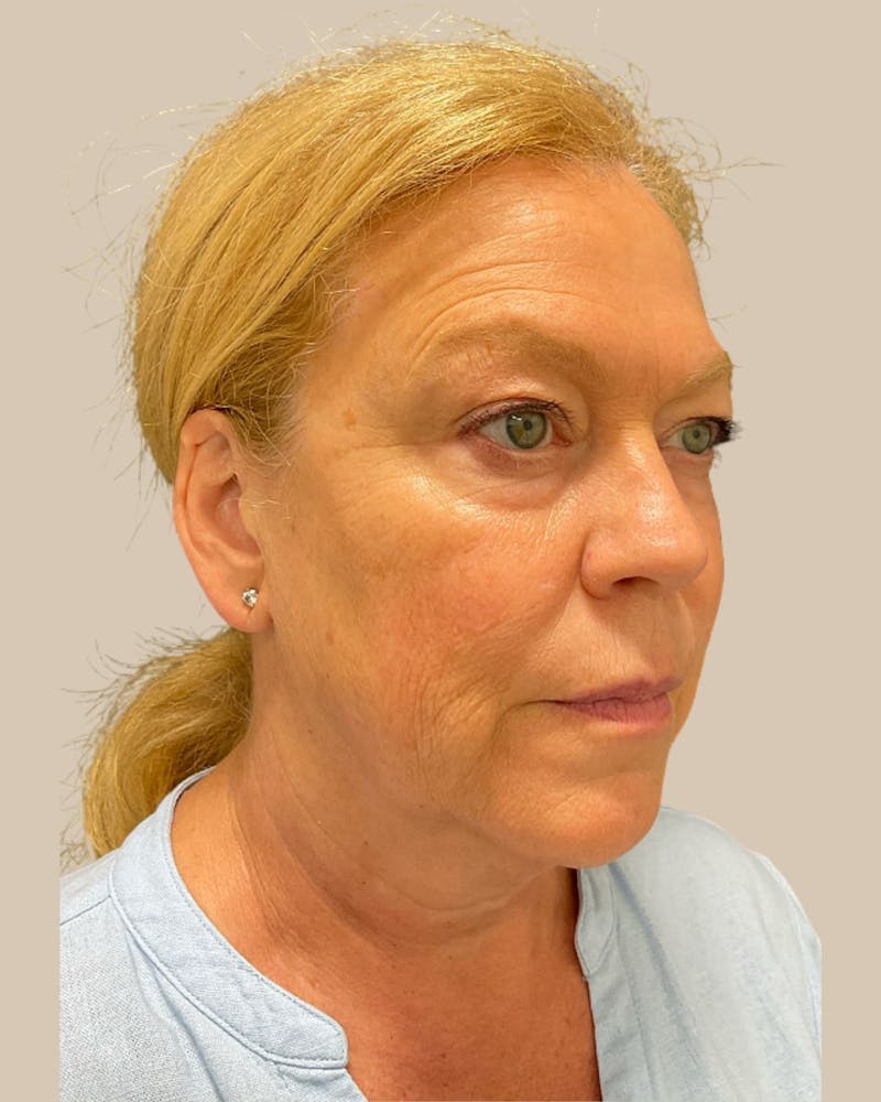 Brow Lift Before & After Gallery - Patient 207716 - Image 5