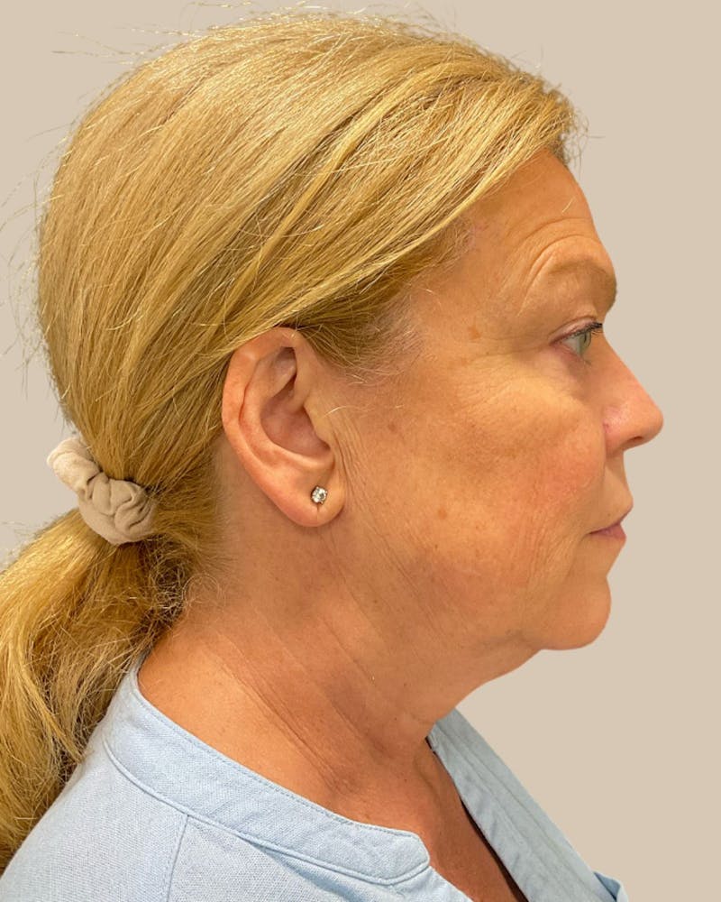 Brow Lift Before & After Gallery - Patient 207716 - Image 7