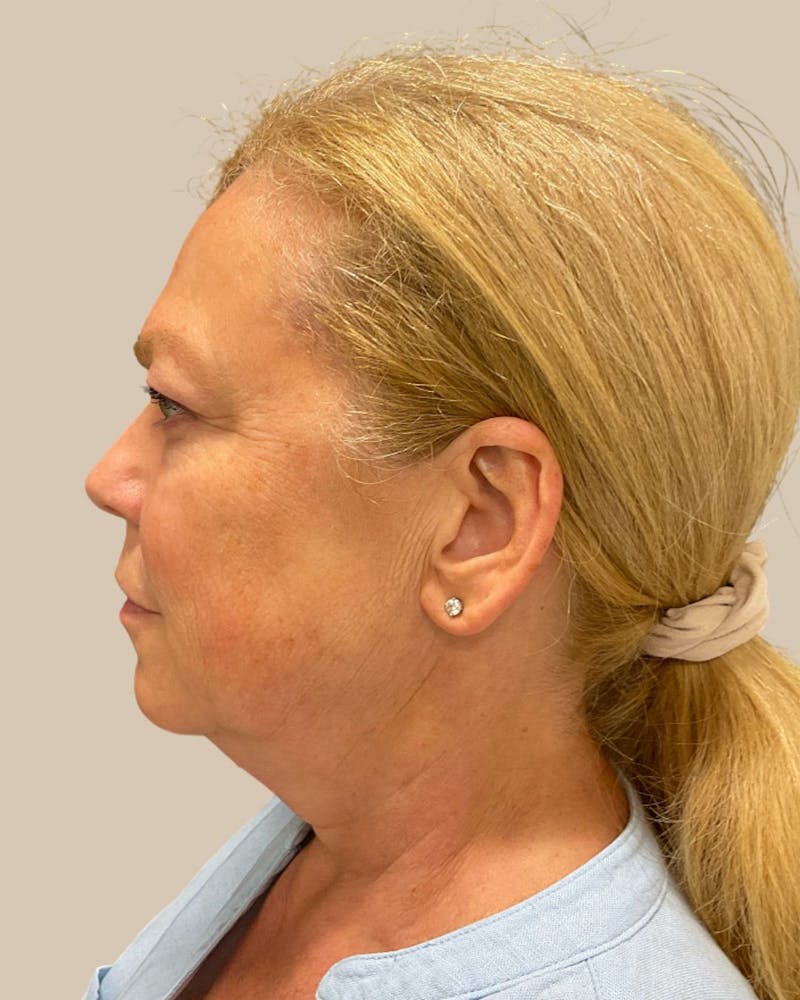 Brow Lift Before & After Gallery - Patient 207716 - Image 9