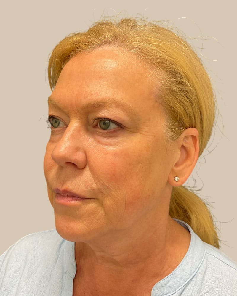 Brow Lift Before & After Gallery - Patient 207716 - Image 1