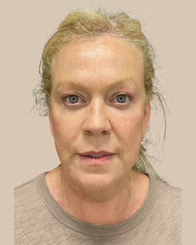 Facelift Before & After Gallery - Patient 257386 - Image 2