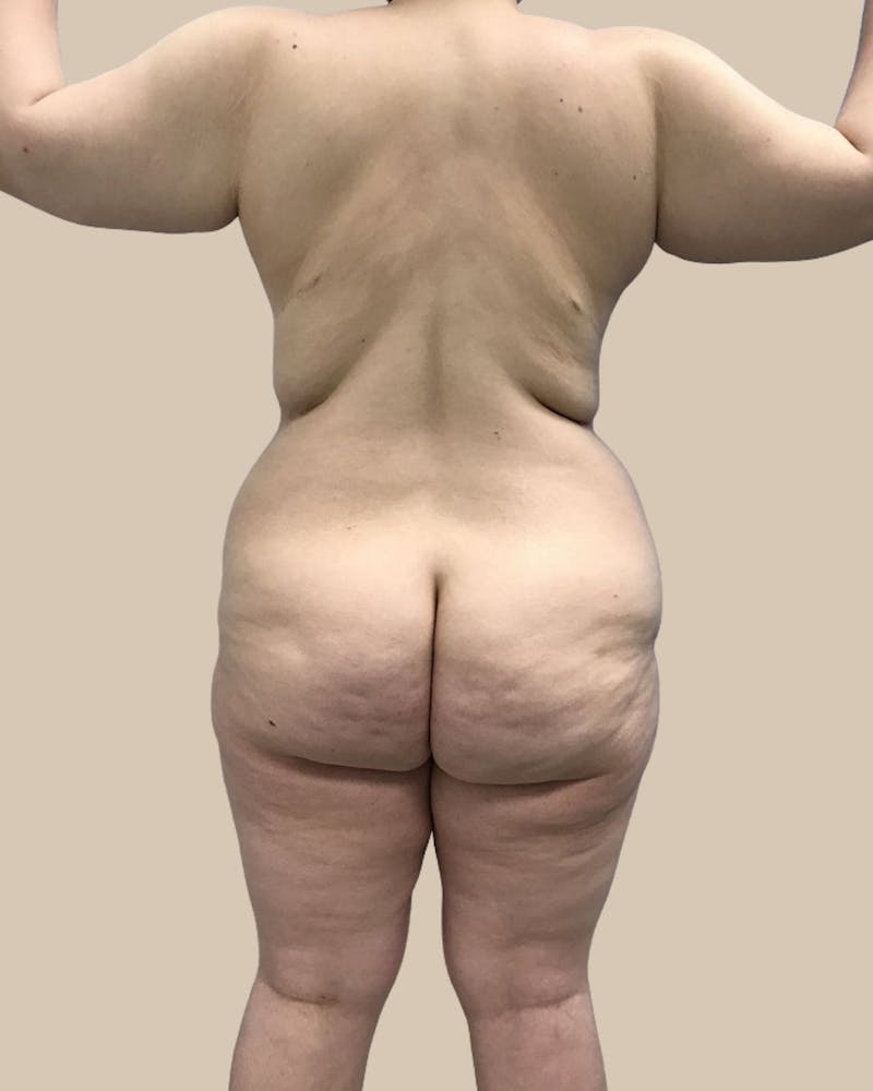 Liposuction Before & After Gallery - Patient 287620 - Image 7