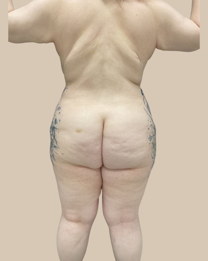 Liposuction Before & After Gallery - Patient 287620 - Image 8