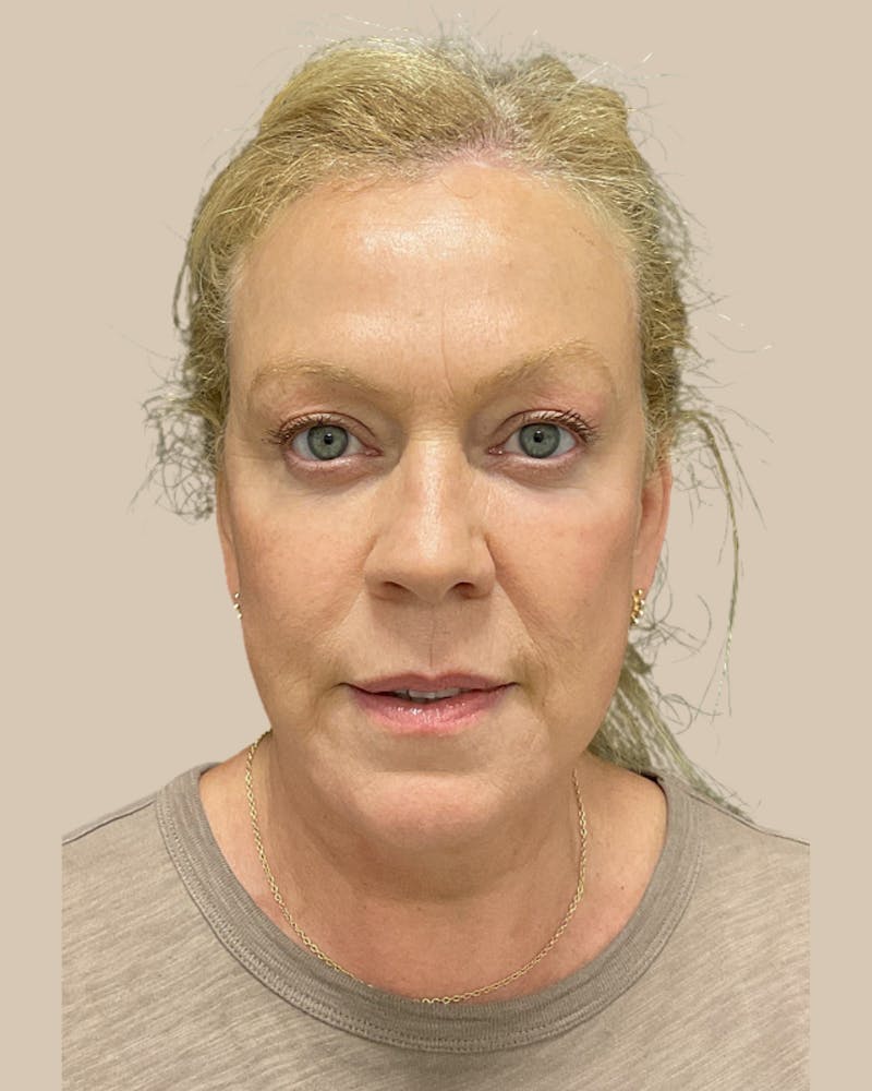 Facelift Before & After Gallery - Patient 257386 - Image 2
