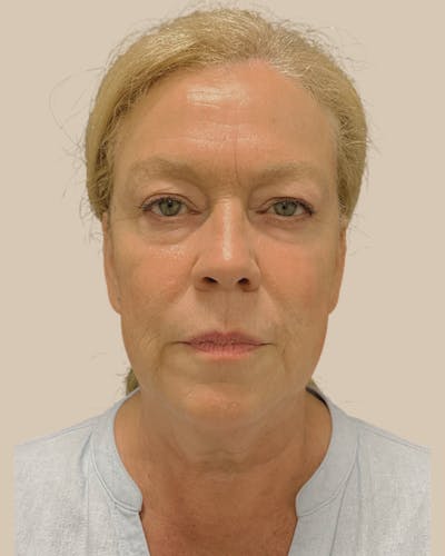 Facelift Before & After Gallery - Patient 257386 - Image 1