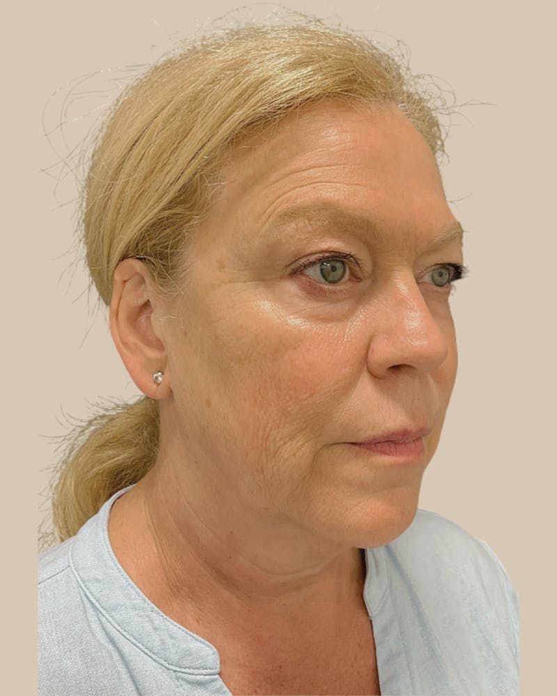 Facelift Before & After Gallery - Patient 257386 - Image 3