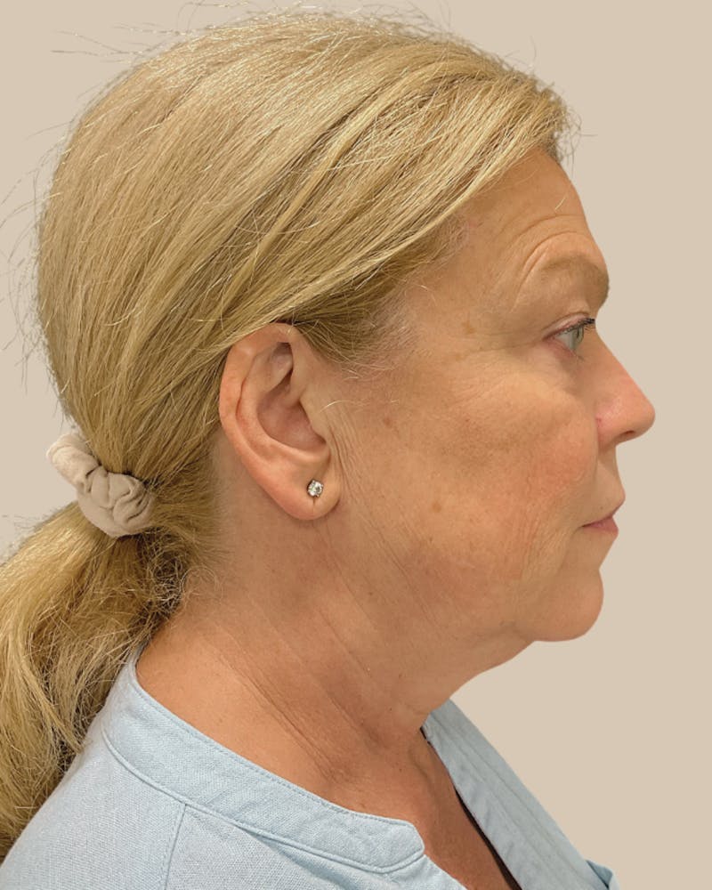 Facelift Before & After Gallery - Patient 257386 - Image 5