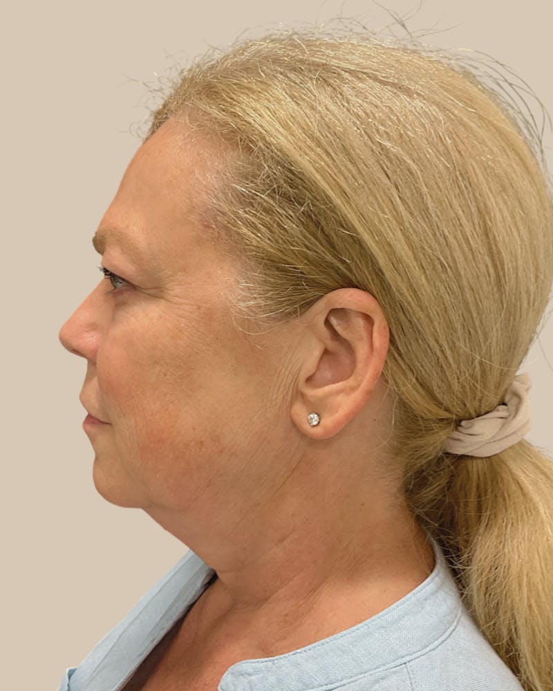 Facelift Before & After Gallery - Patient 257386 - Image 7