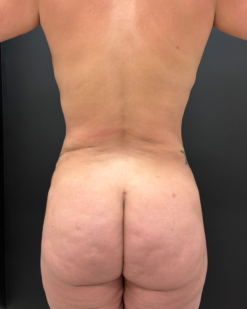 After alloeclae image