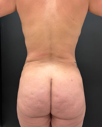 Alloclae Before & After Gallery - Patient 721530 - Image 2