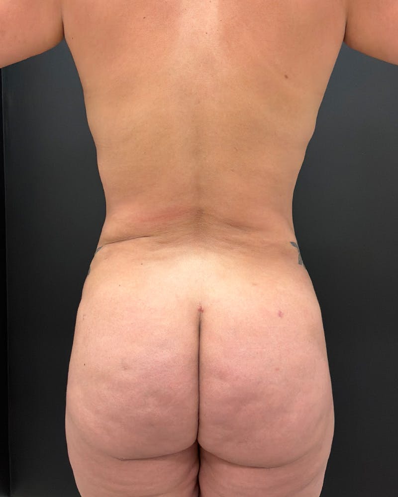 Alloclae Before & After Gallery - Patient 257786 - Image 2