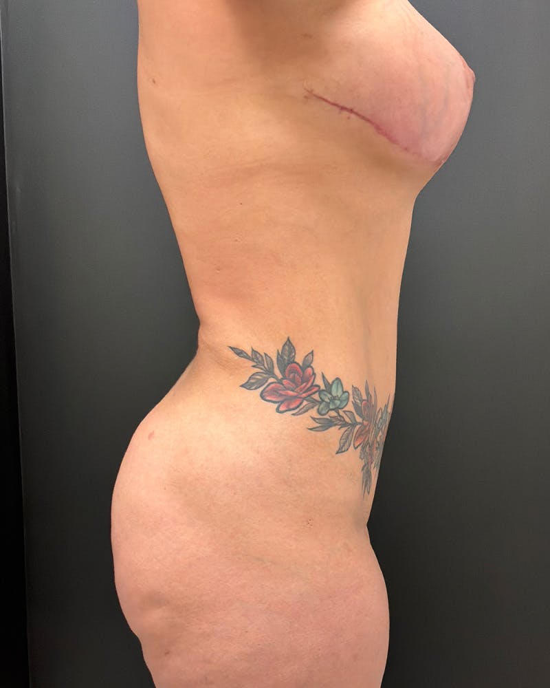 Alloclae Before & After Gallery - Patient 257786 - Image 6