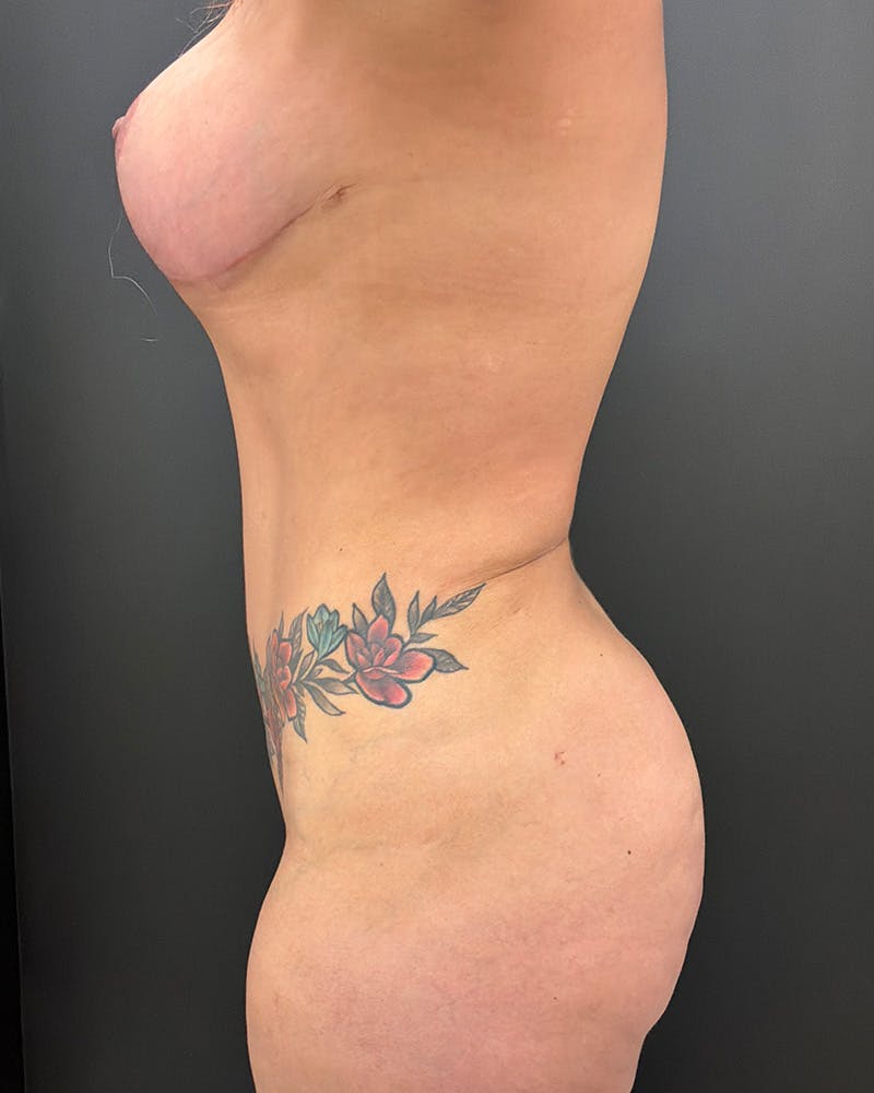 Alloclae Before & After Gallery - Patient 257786 - Image 10