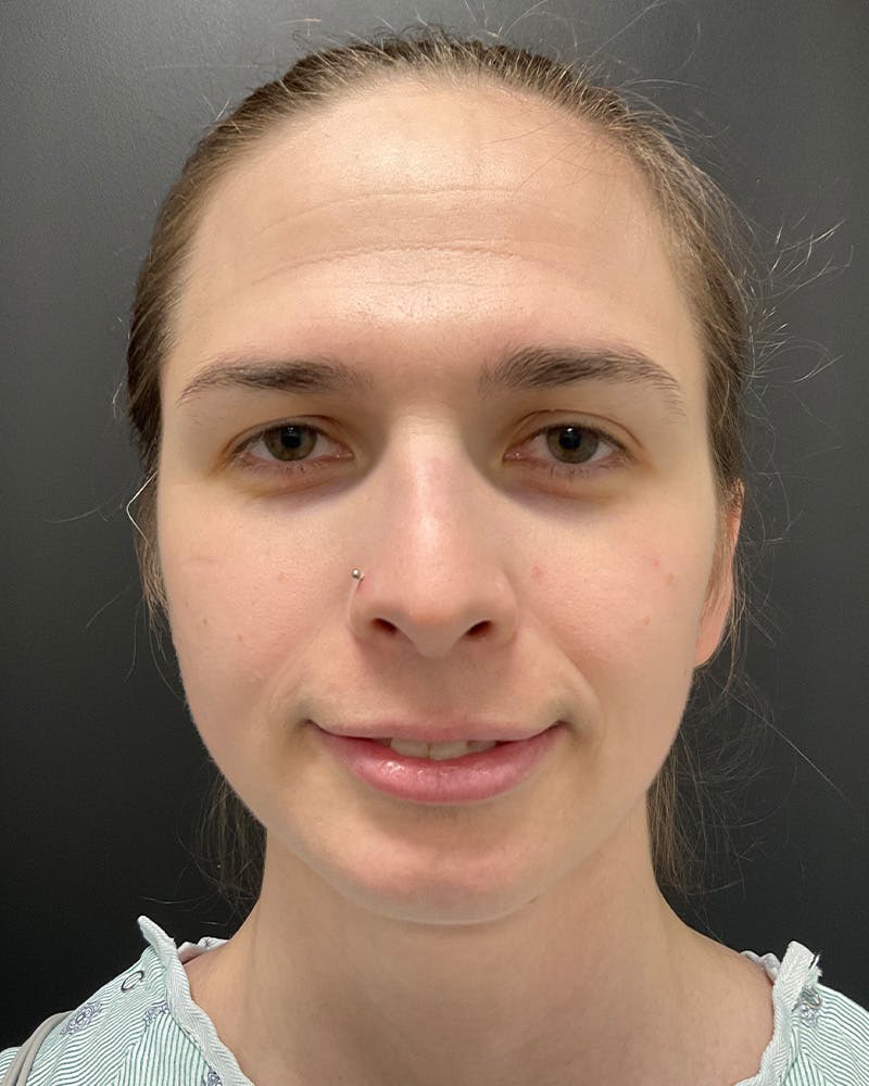 Facial Feminization Before & After Gallery - Patient 342426 - Image 1