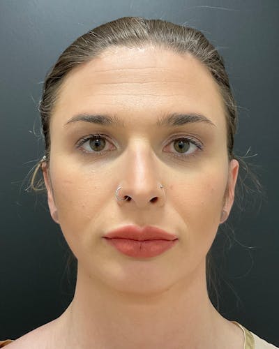 Facial Feminization Before & After Gallery - Patient 342426 - Image 2