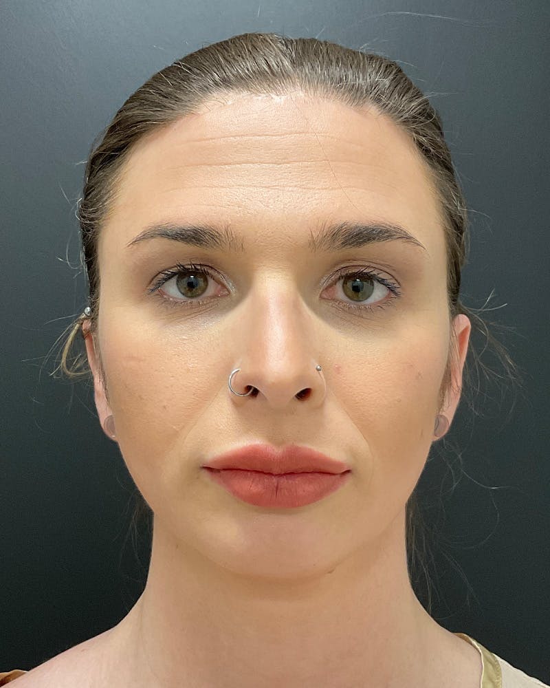 Facial Feminization Before & After Gallery - Patient 342426 - Image 2