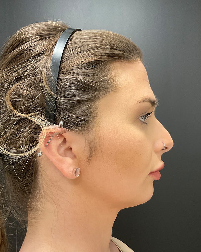 Facial Feminization Before & After Gallery - Patient 342426 - Image 6