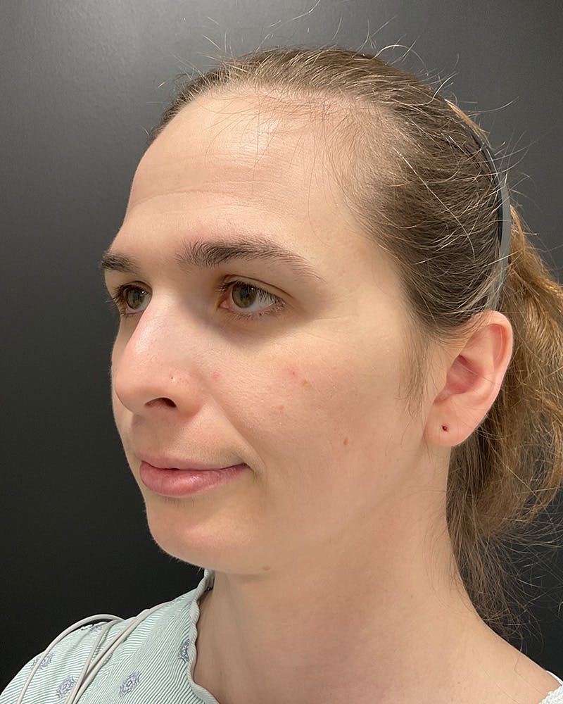Facial Feminization Before & After Gallery - Patient 342426 - Image 7