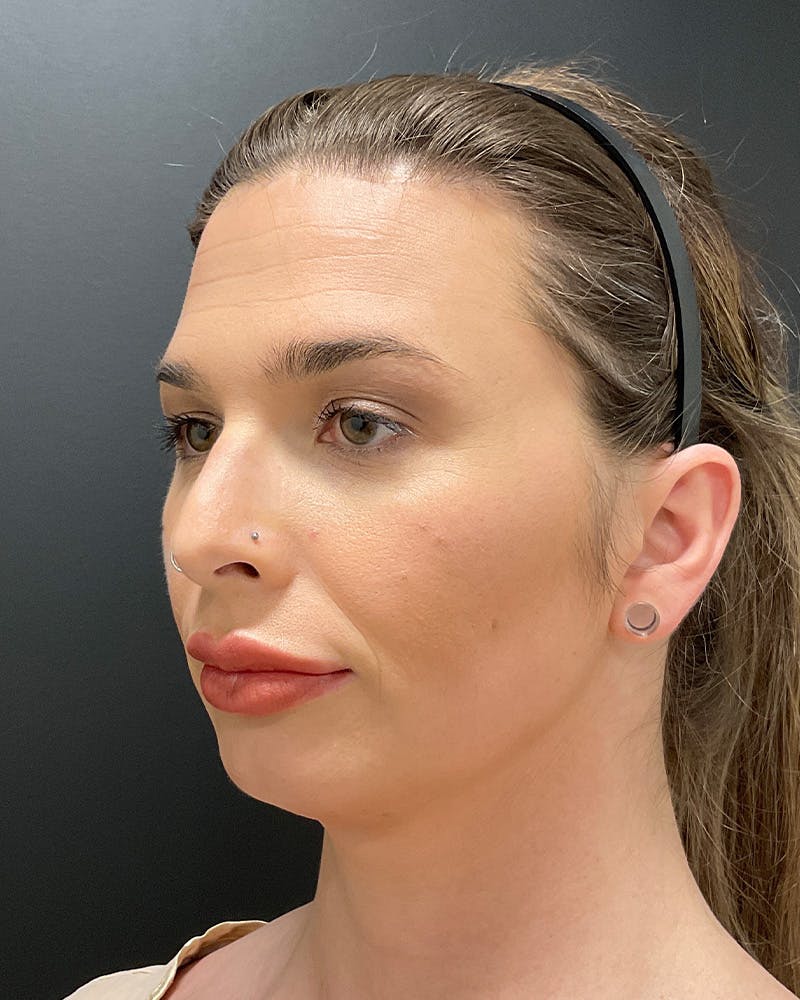 Facial Feminization Before & After Gallery - Patient 342426 - Image 8
