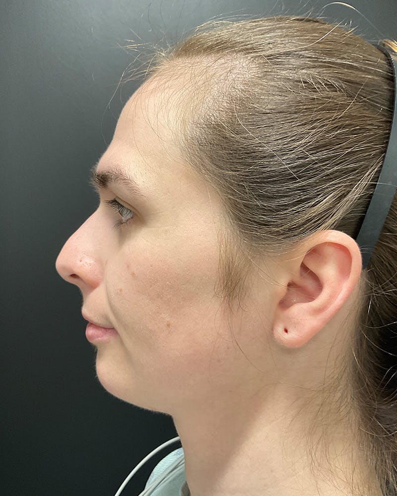 Facial Feminization Before & After Gallery - Patient 342426 - Image 9