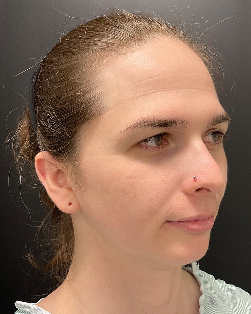Facial Feminization Before & After Gallery - Patient 342426 - Image 3